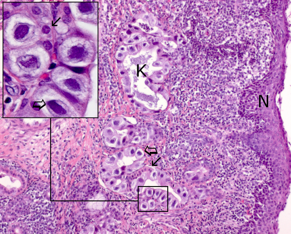 Figur 1. Histologisk billede af næseslimhinde (N) fra svin med PCMV infektion. I slimhinden ses kirtler (K) med PCMV inficerede epithel celler  med virus inklusionslegeme i cellekernen (bred pil) og normale epithel celler (smal pil). Foto: DTU Vet