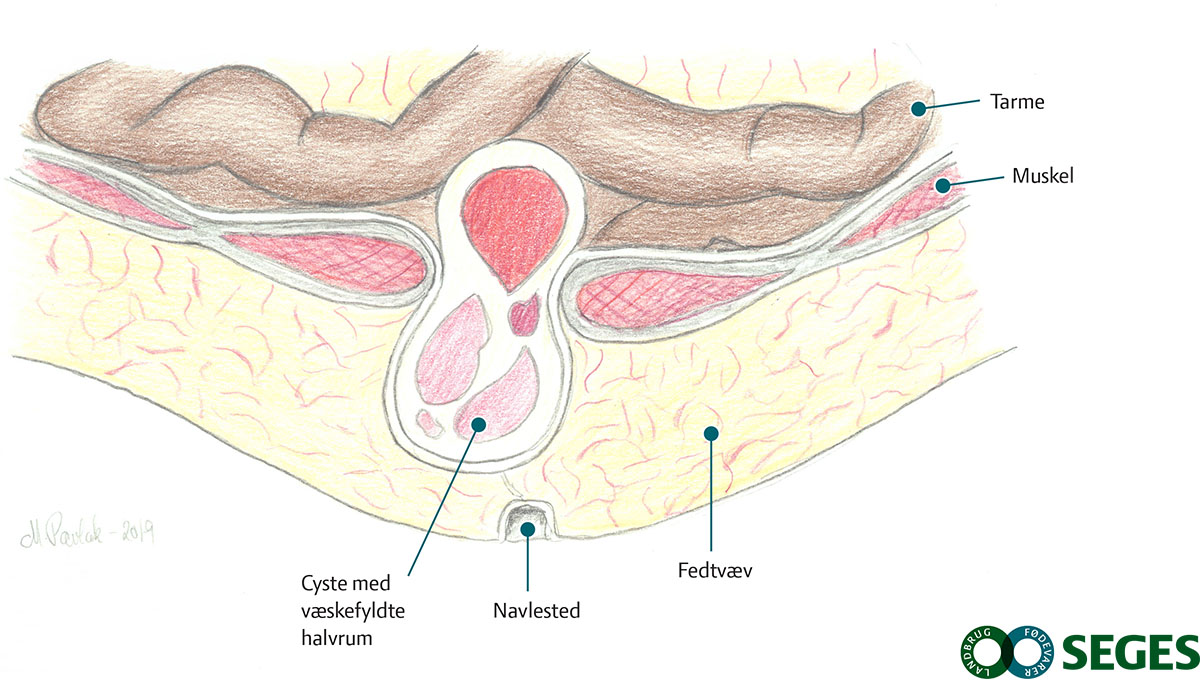 Tegning af en cyste ved navlestedet hos en gris.